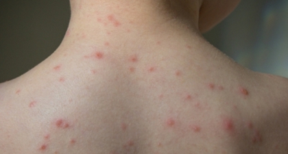 Dampak Herpes Zoster