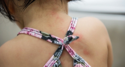 Kenali Penyebab dan Pencegahan Cacar Air pada Anak