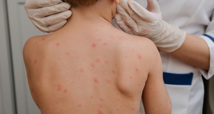 Biduran pada Anak, Ini Penyebab dan Cara Mengatasinya