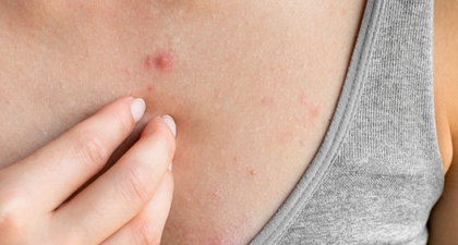Cara Ampuh Mengobati Bintik Merah pada Kulit yang Disertai Gatal