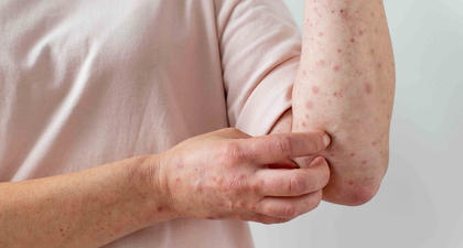 Ini Perbedaan Campak dan Alergi yang Perlu Moms Pahami