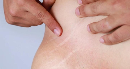 Cuma Bisa Pudar, Ini Perbedaan Stretch Mark Merah dan Putih