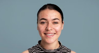 Punya Bekas Jerawat Kemerahan? Begini Cara Menghilangkannya