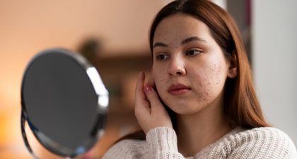 5 Manfaat Niacinamide untuk Mengatasi Kulit Berjerawat