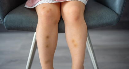 Jangan Anggap Enteng Bekas Luka Si Kecil! Gunakan Produk yang Cocok dan Efektif untuk Merawatnya