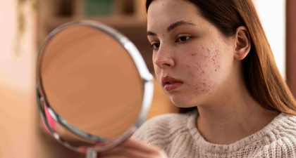 8 Cara Menghilangkan Bekas Jerawat Secara Alami