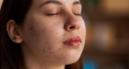 Bukan Cuma Salah Skincare, Ini Penyebab Bruntusan di Pipi