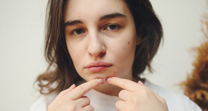 Jangan Panik! Ini Cara Alami untuk Menghilangkan Bekas Jerawat