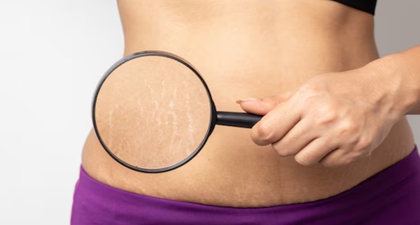 5 Cara Mengurangi Stretch Mark dengan Bahan Alami