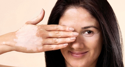 Warna Kulit Bisa Berubah, Waspada Faktor Penyebabnya