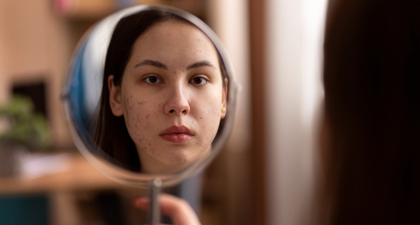 Ini Makanan yang Bikin Jerawatan, Batasi Konsumsinya, Moms!