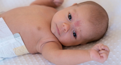 Scabies pada Bayi, Ini Gejala, Penyebab, dan Cara Mengatasinya