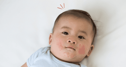 Penyebab Kulit Bayi Kemerahan dan Cara Tepat untuk Mengatasinya