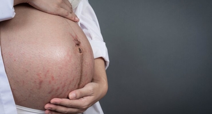 Kulit Gatal saat Hamil, Ini Cara Efektif Mengatasinya