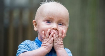 Bayi Asal Inggris Tidak Bisa Berkedip  