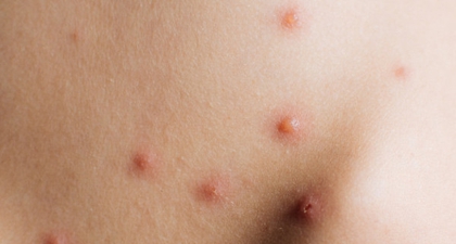 Hati-Hati! Orang Dewasa Juga Bisa Kena Cacar Air, Lho