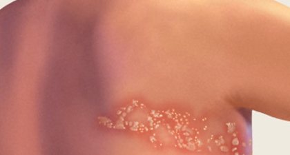 Mengenal Cacar Ular, Lebih Berbahaya Daripada Cacar Air