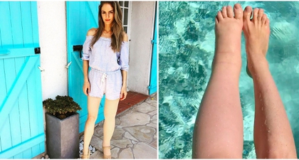 Kaki Wanita Ini Bengkak Sebelah Sejak Hamil