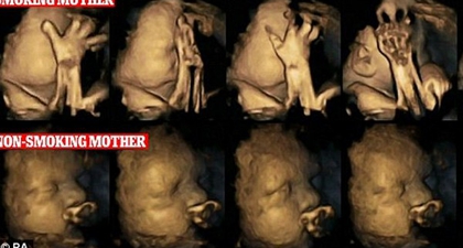 Hasil USG Bayi dengan Ibu Perokok