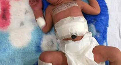 Bayi dengan Kembar Parasit Berhasil Dioperasi