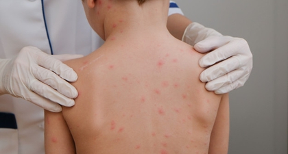 Mungkinkah Kena Cacar Air Dua Kali? Ini Jawabannya