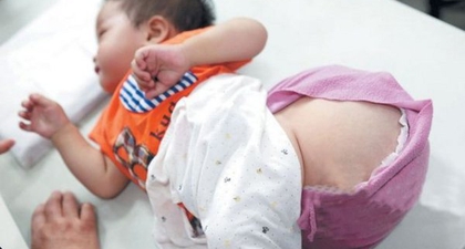 Anak Menderita Tumor Sebesar Melon 