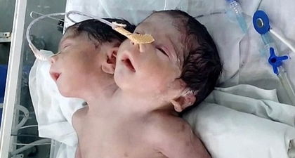 Bayi Berkepala 2 Ini Hanya Bertahan Hidup 32 Jam