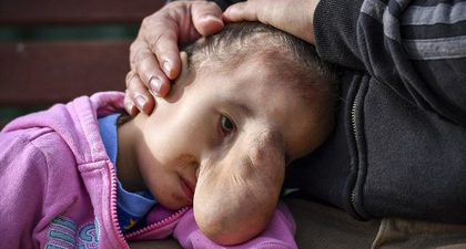 Balita Ini Disebut 'Monster' karena Penyakitnya