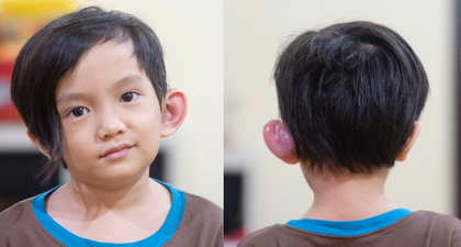 Anak Musisi Anji, Saga, Terkena Sinus Preauricular