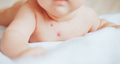 Waspada! Bahaya Cacar Monyet atau Monkeypox pada Anak