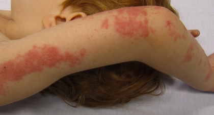 Waspada! Setelah Cacar Air, Anak bisa Terkena Cacar Api