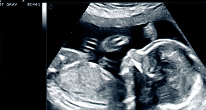 Mengenal Sindrom Turner, Kelainan Genetik pada Bayi